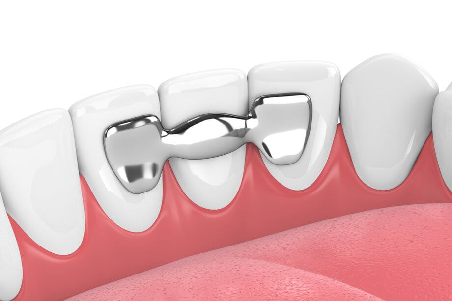 How Long Does a Dental Bridge Last?